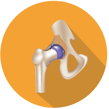 Osteoporosis Osteoporosis